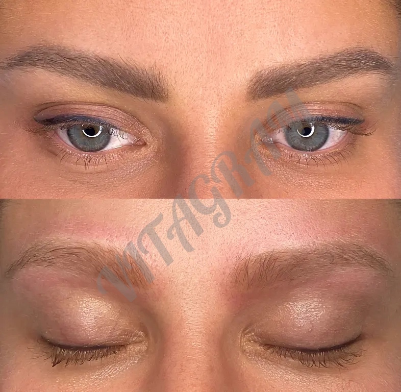 Удаление тату и татуажа на пикосекундном лазере