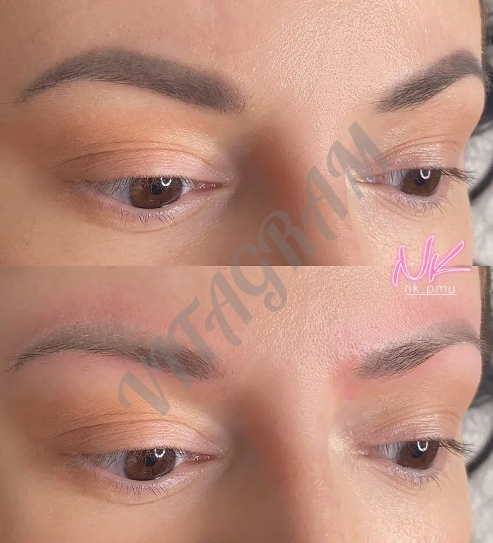 Удаление тату и татуажа на пикосекундном лазере