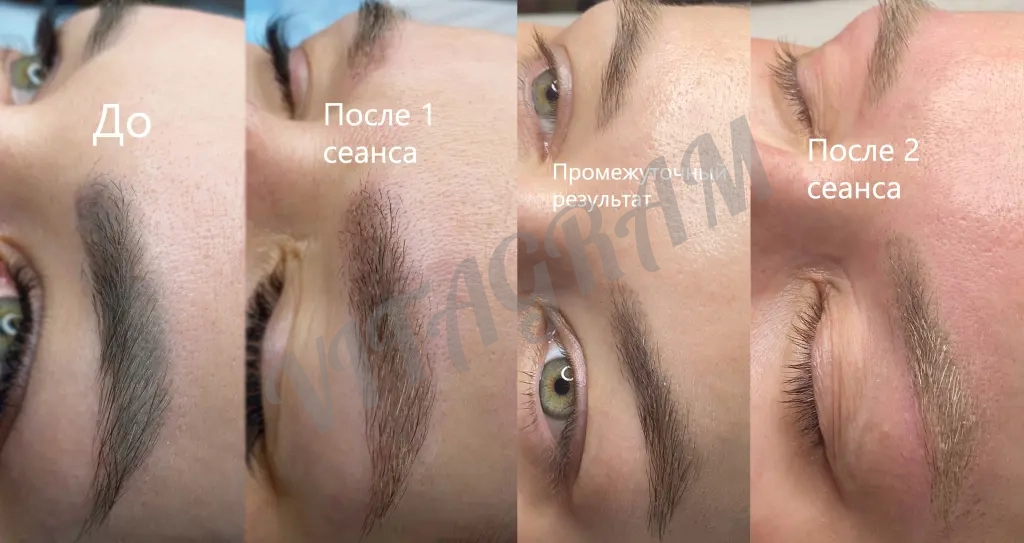 Удаление тату и татуажа на пикосекундном лазере